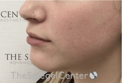 Lip Filler Before & After Gallery - Patient 108297 - Image 5