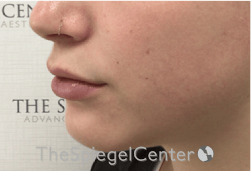 Lip Filler Before & After Gallery - Patient 108297 - Image 6