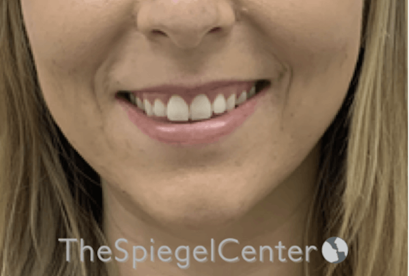 Lip Filler Before & After Gallery - Patient 717529 - Image 1