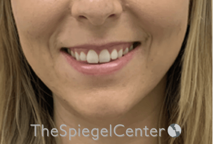 Lip Filler Before & After Gallery - Patient 717529 - Image 1