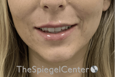 Lip Filler Before & After Gallery - Patient 717529 - Image 2