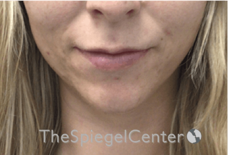 Lip Filler Before & After Gallery - Patient 717529 - Image 3
