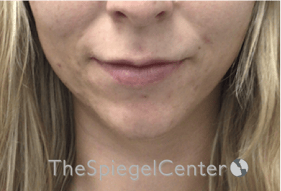 Lip Filler Before & After Gallery - Patient 717529 - Image 3