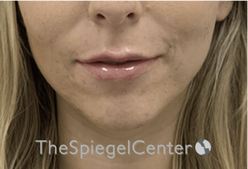 Lip Filler Before & After Gallery - Patient 717529 - Image 4