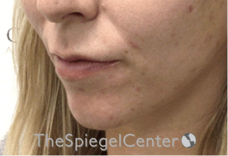 Lip Filler Before & After Gallery - Patient 717529 - Image 5