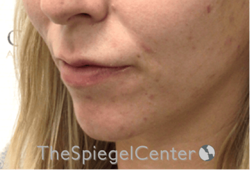 Lip Filler Before & After Gallery - Patient 717529 - Image 5