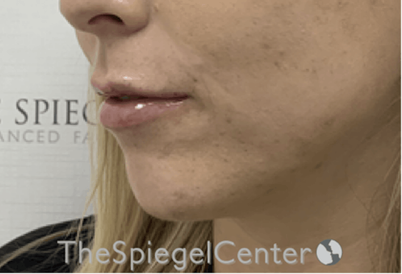 Lip Filler Before & After Gallery - Patient 717529 - Image 6