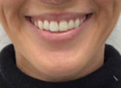 Lip Filler Before & After Gallery - Patient 312075 - Image 1