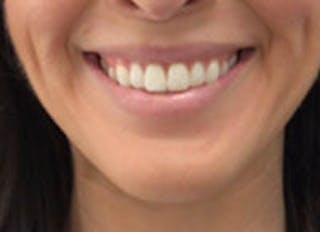 Lip Filler Before & After Gallery - Patient 312075 - Image 2