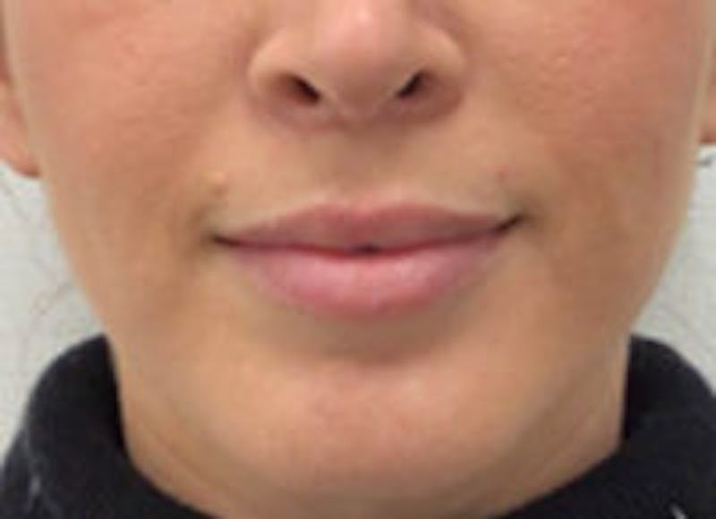 Lip Filler Before & After Gallery - Patient 312075 - Image 3