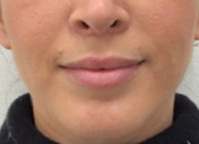 Lip Filler Before & After Gallery - Patient 312075 - Image 3