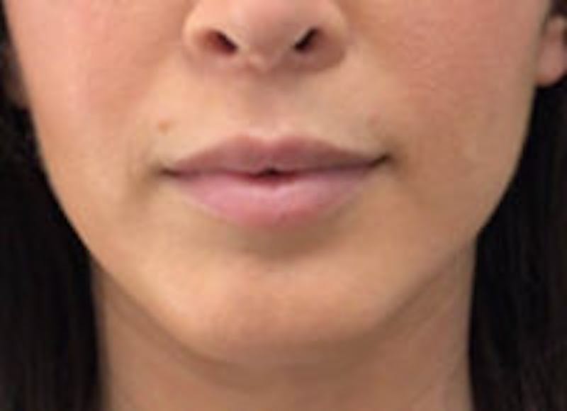 Lip Filler Before & After Gallery - Patient 312075 - Image 4