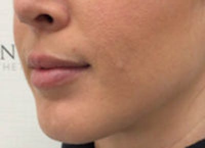 Lip Filler Before & After Gallery - Patient 312075 - Image 5