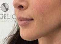 Lip Filler Before & After Gallery - Patient 312075 - Image 6