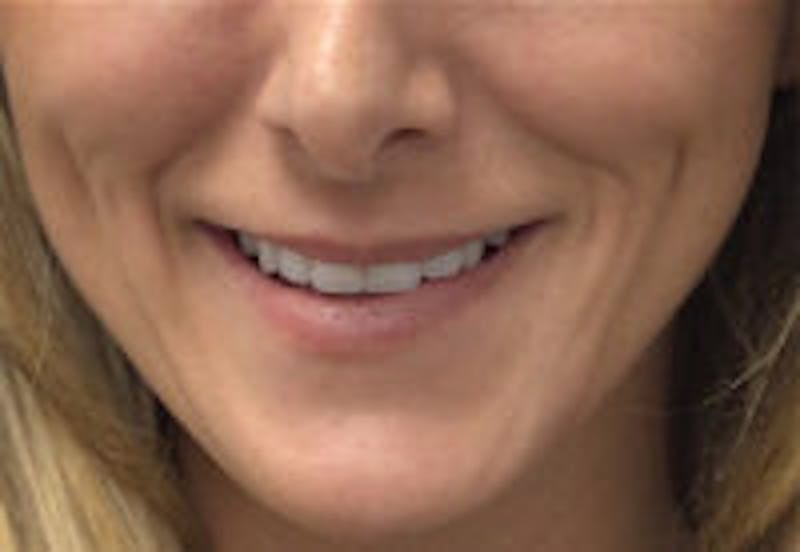 Lip Filler Before & After Gallery - Patient 122379 - Image 1