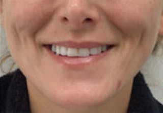 Lip Filler Before & After Gallery - Patient 122379 - Image 2