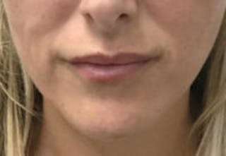 Lip Filler Before & After Gallery - Patient 122379 - Image 4