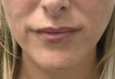 Lip Filler Before & After Gallery - Patient 122379 - Image 4