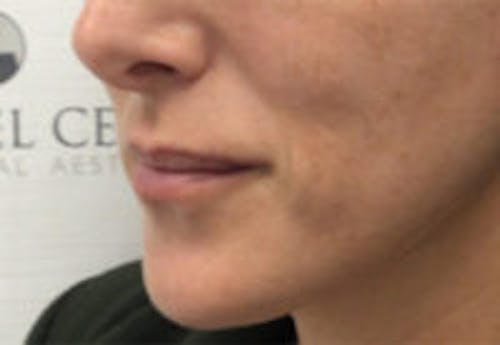 Lip Filler Before & After Gallery - Patient 122379 - Image 5