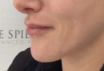 Lip Filler Before & After Gallery - Patient 122379 - Image 6