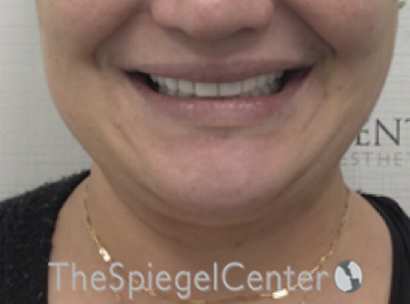 Lip Filler Before & After Gallery - Patient 357555 - Image 1