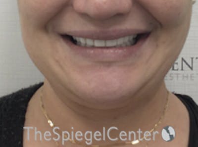 Lip Filler Before & After Gallery - Patient 357555 - Image 1