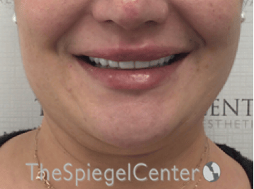 Lip Filler Before & After Gallery - Patient 357555 - Image 2