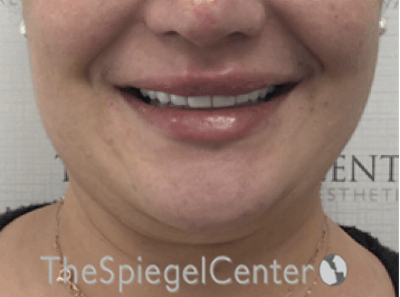 Lip Filler Before & After Gallery - Patient 357555 - Image 2