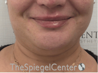 Lip Filler Before & After Gallery - Patient 357555 - Image 4