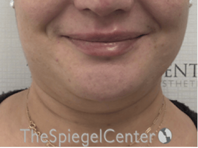 Lip Filler Before & After Gallery - Patient 357555 - Image 4