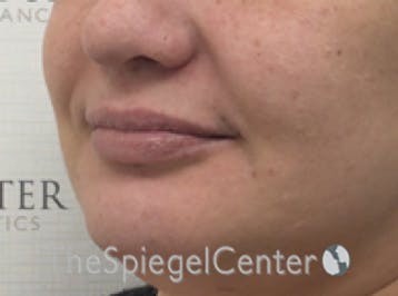 Lip Filler Before & After Gallery - Patient 357555 - Image 5