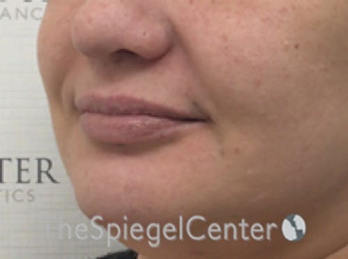 Lip Filler Before & After Gallery - Patient 357555 - Image 5