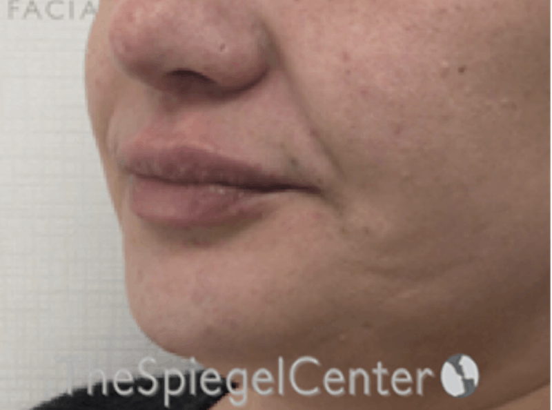 Lip Filler Before & After Gallery - Patient 357555 - Image 6