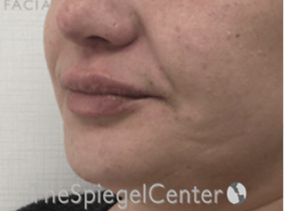 Lip Filler Before & After Gallery - Patient 357555 - Image 6