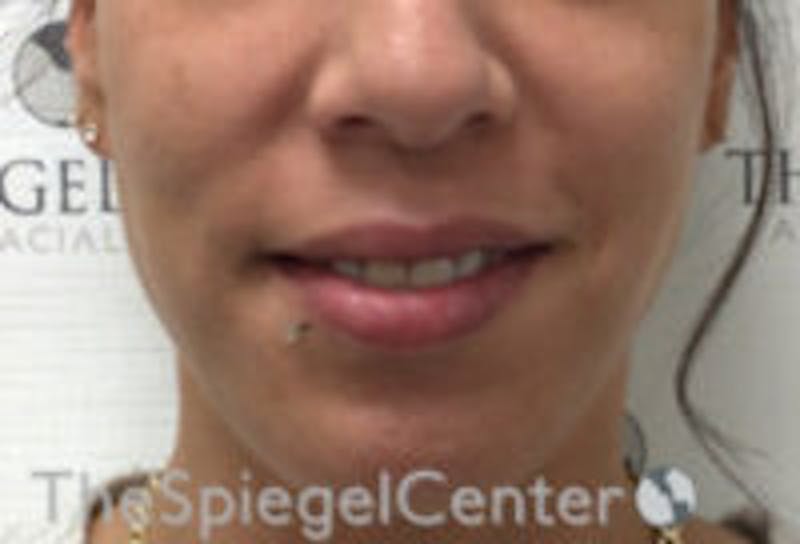 Lip Filler Before & After Gallery - Patient 147054 - Image 1