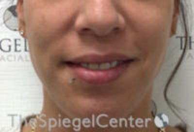 Lip Filler Before & After Gallery - Patient 147054 - Image 1