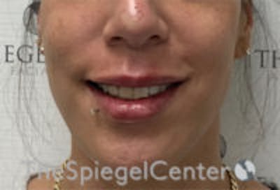 Lip Filler Before & After Gallery - Patient 147054 - Image 2