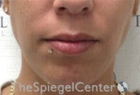 Lip Filler Before & After Gallery - Patient 147054 - Image 3