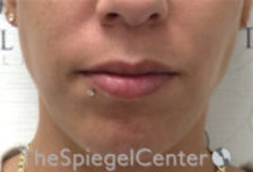 Lip Filler Before & After Gallery - Patient 147054 - Image 3