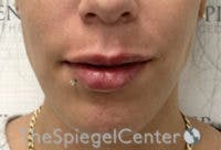 Lip Filler Before & After Gallery - Patient 147054 - Image 4