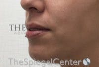 Lip Filler Before & After Gallery - Patient 147054 - Image 5