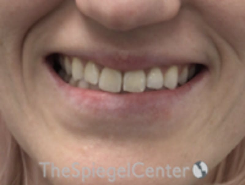 Lip Filler Before & After Gallery - Patient 543966 - Image 1