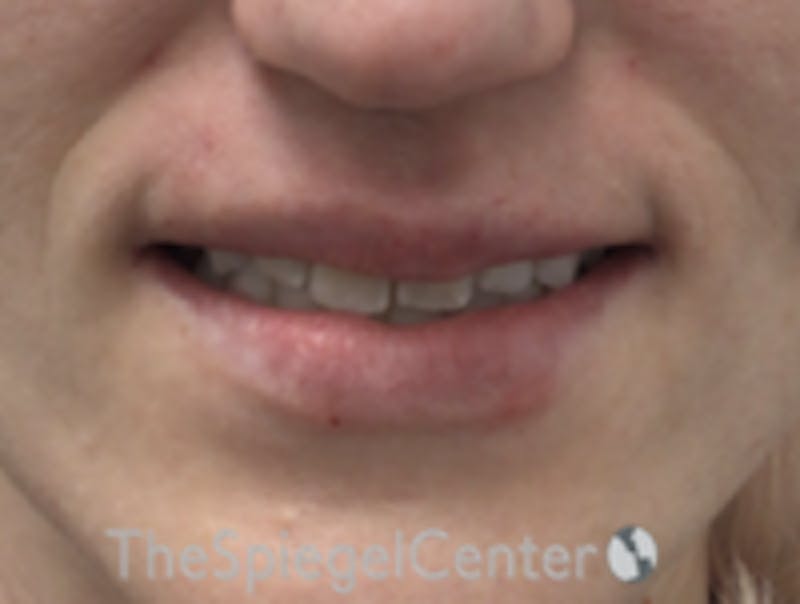 Lip Filler Before & After Gallery - Patient 543966 - Image 2