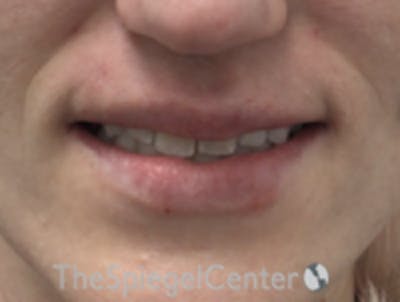 Lip Filler Before & After Gallery - Patient 543966 - Image 2