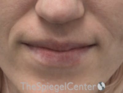 Lip Filler Before & After Gallery - Patient 543966 - Image 3