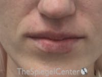 Lip Filler Before & After Gallery - Patient 543966 - Image 4