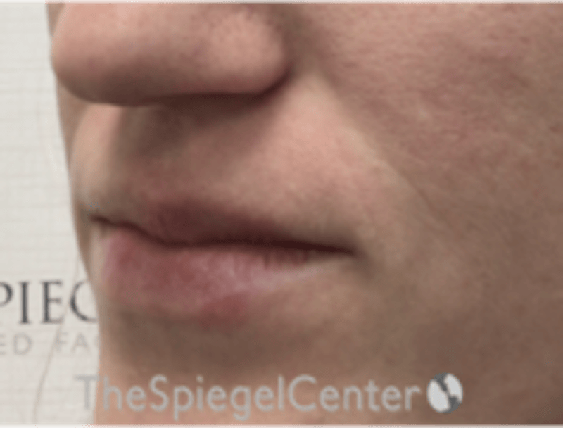 Lip Filler Before & After Gallery - Patient 543966 - Image 5