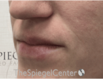 Lip Filler Before & After Gallery - Patient 543966 - Image 5