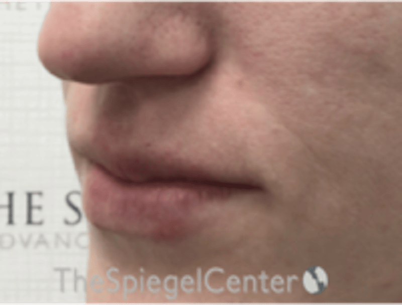 Lip Filler Before & After Gallery - Patient 543966 - Image 6