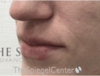 Lip Filler Before & After Gallery - Patient 543966 - Image 6